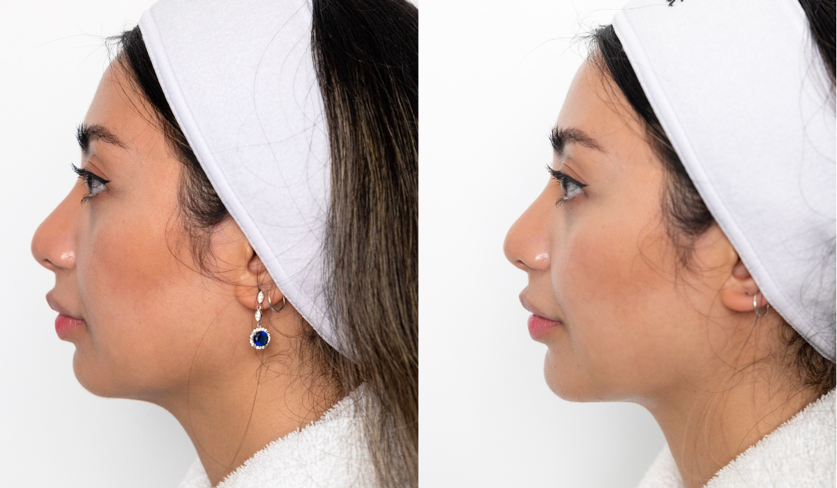 Before and after chin filler