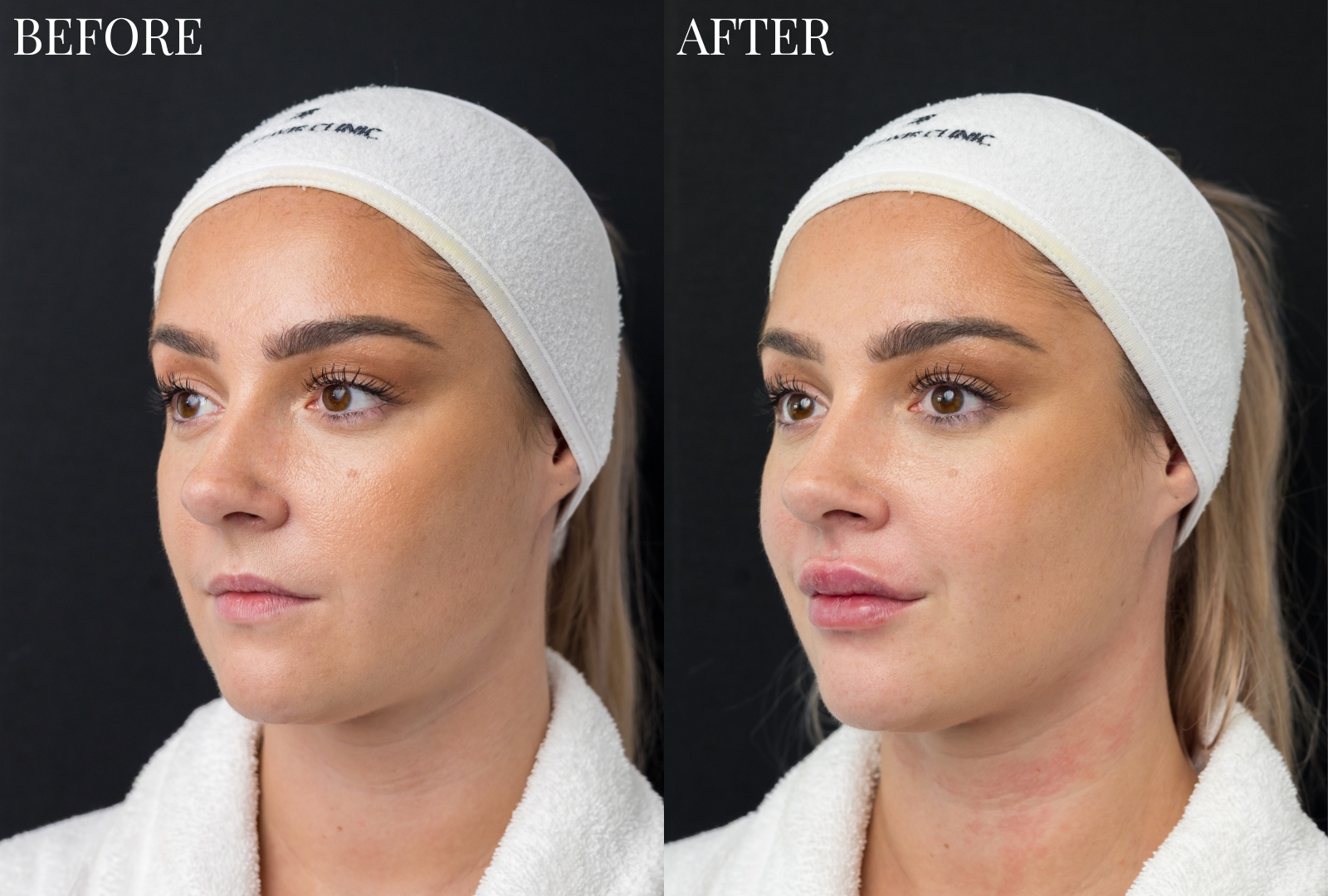 Before and after lip filler treatment at The Elixir Clinic