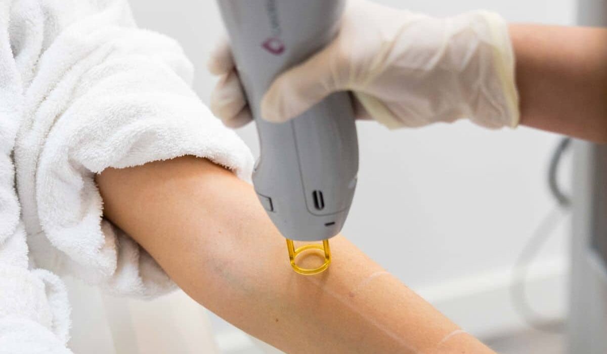 expect-candela-laser-hair-removal-treatments