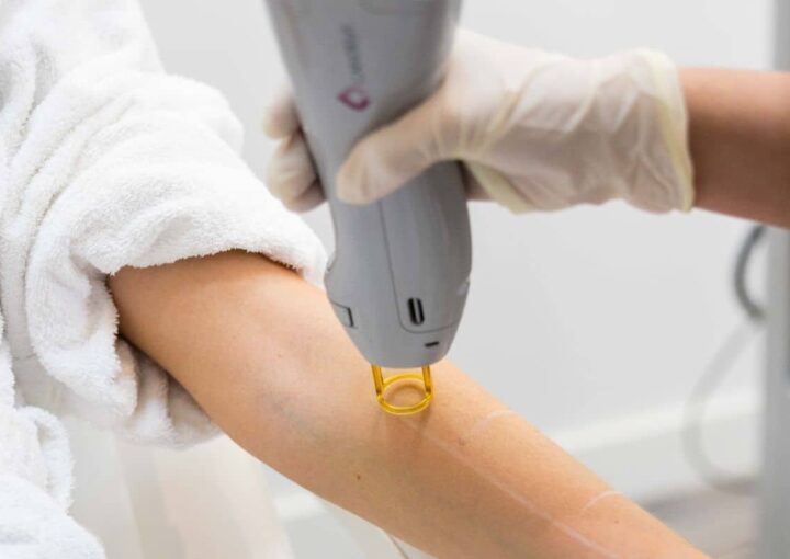 expect-candela-laser-hair-removal-treatments