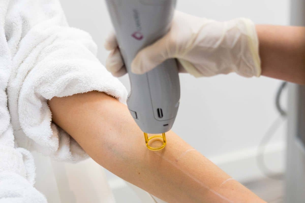 expect-candela-laser-hair-removal-treatments